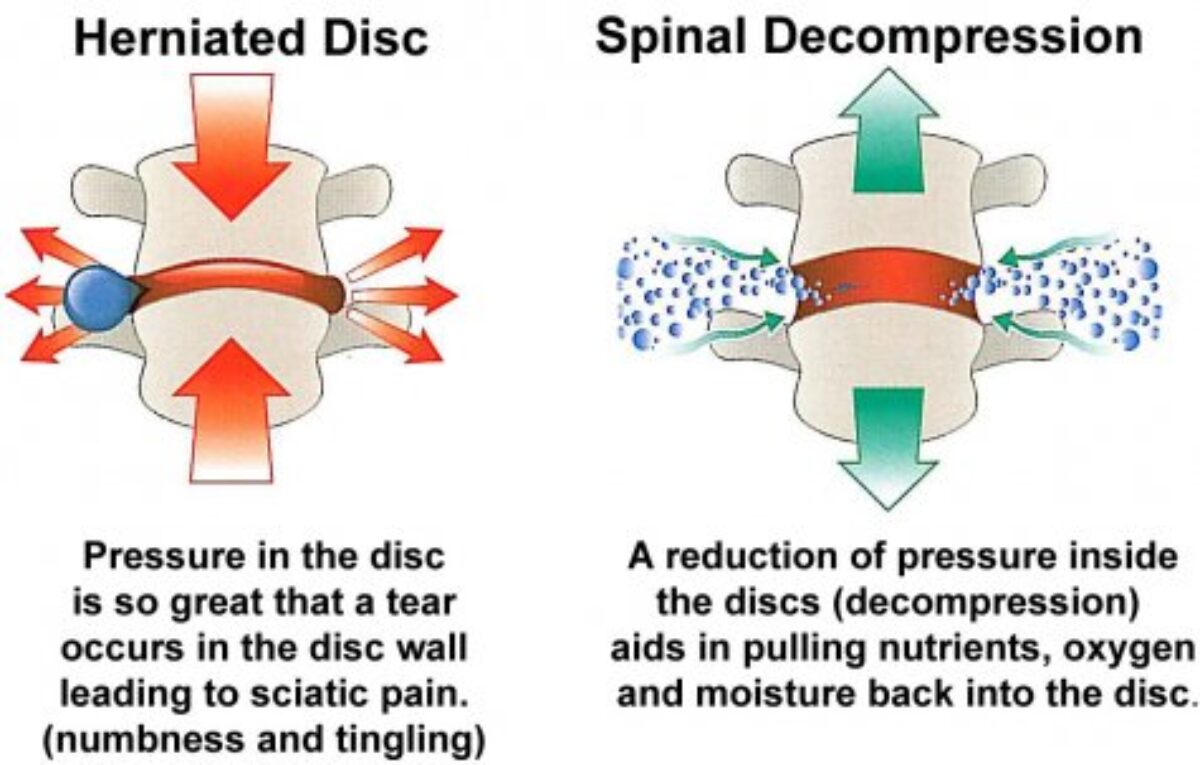 Chiropractic Treatment for Disc Herniation - Advanced Wellness Solutions