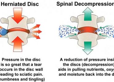 What is spinal decompression and how it could help