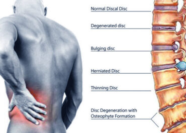 Disc injuries and how seeing a chiropractor could help